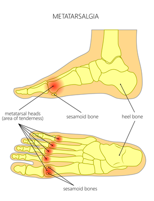 metatarsalgia
