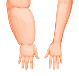 lymphedema
