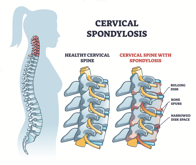 spondiloza cervicala