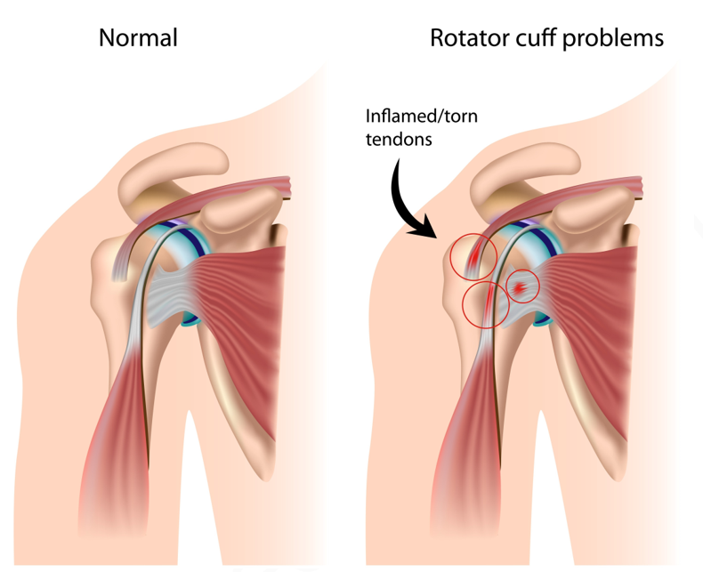 tendinopatia umarului