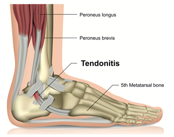 peroneal tendinitis