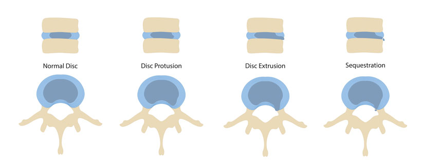 radiculopatia lombara