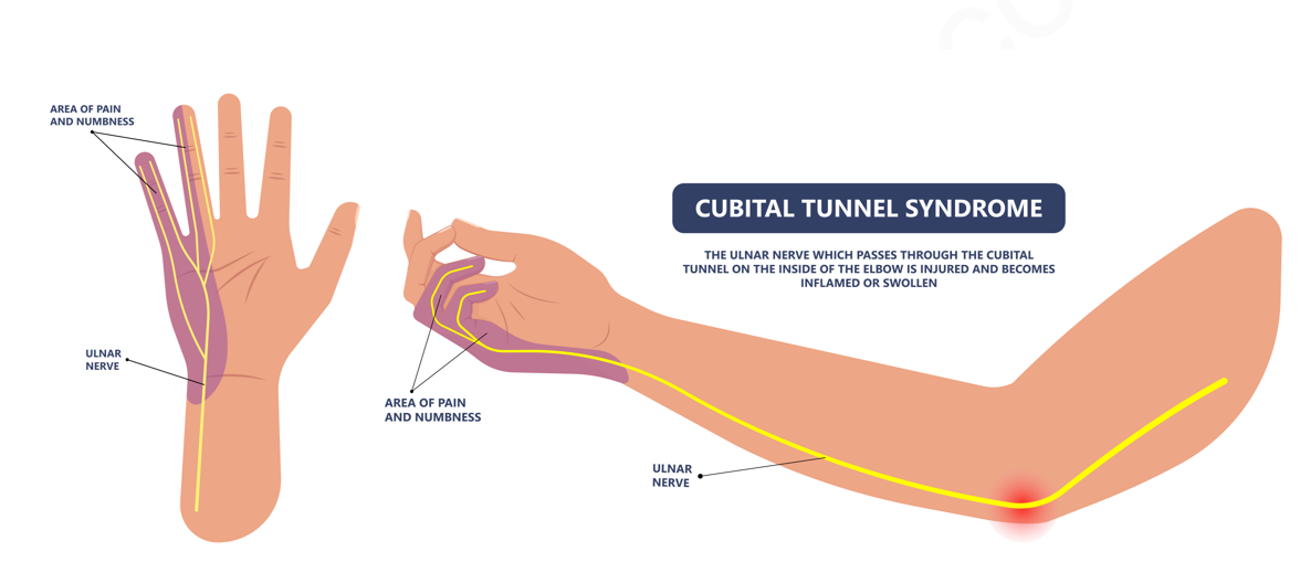 tunnel syndrome