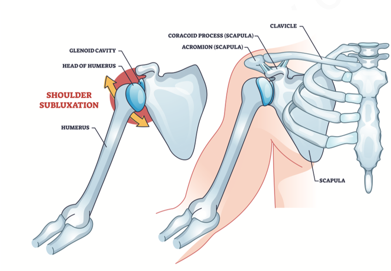 shoulder subluxation