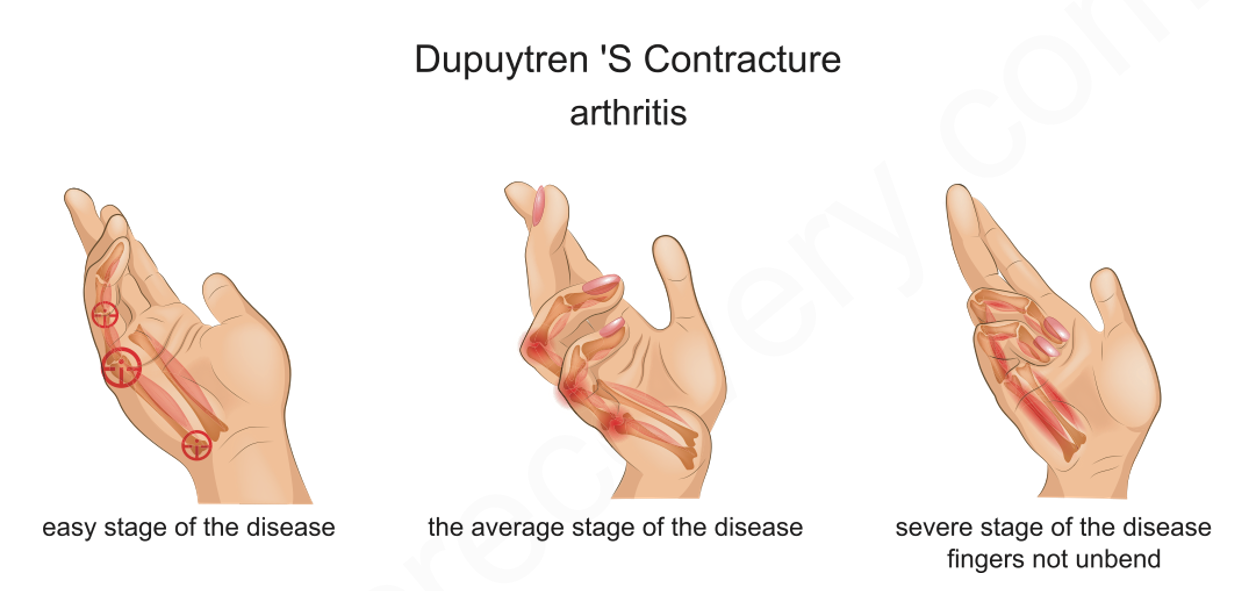 contracture