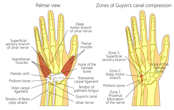 Guyon syndrome