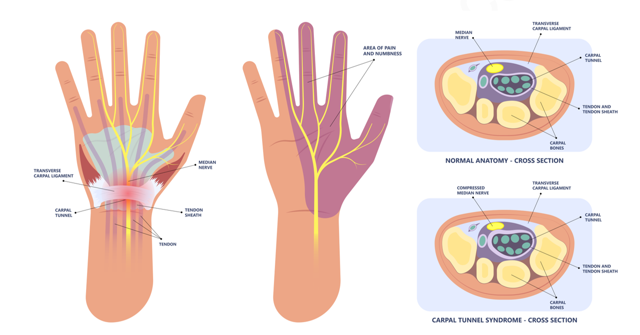 carpian syndrome