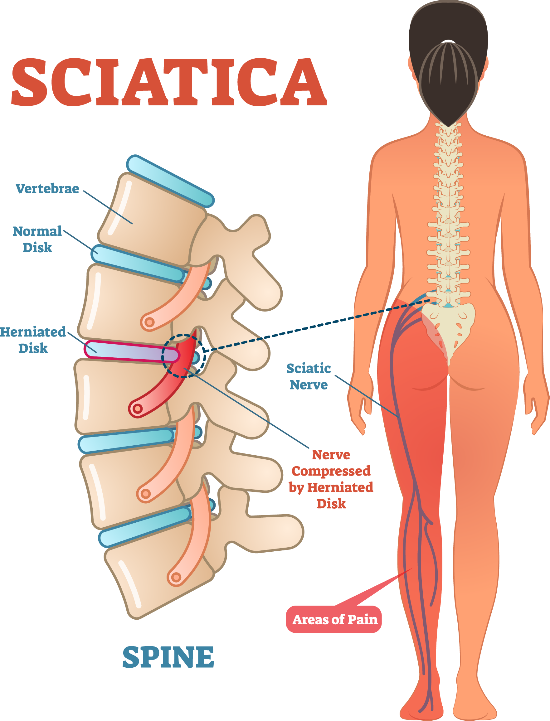 lombosciatica