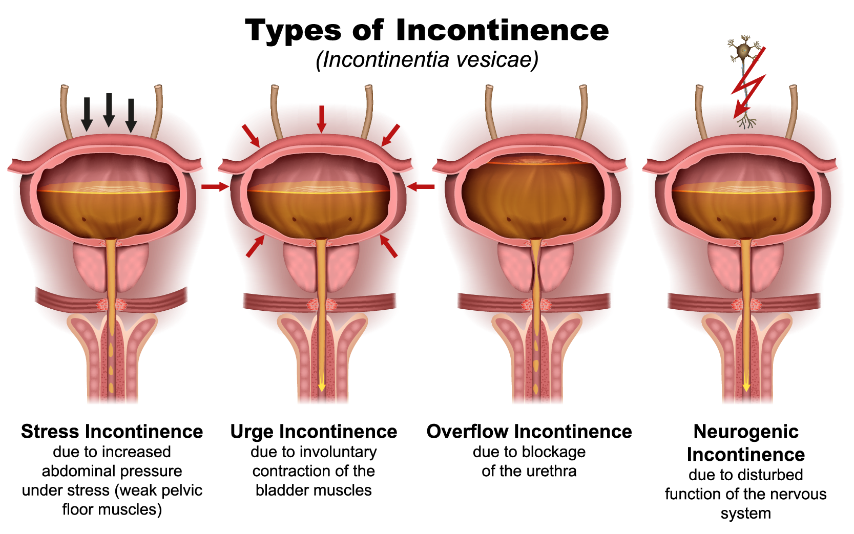 incontinence
