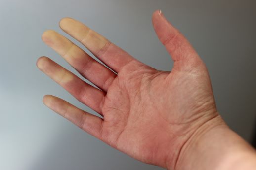 raynaud