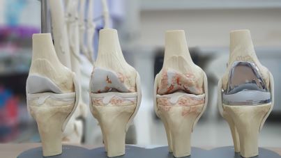 knee prosthesis
