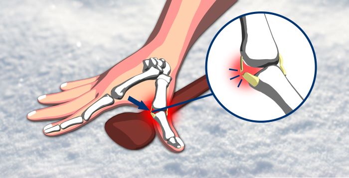 degetul mare al schiorului