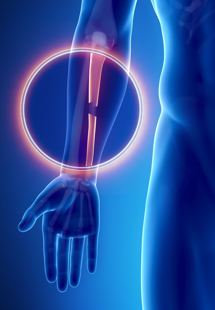 fractura distala de ulna