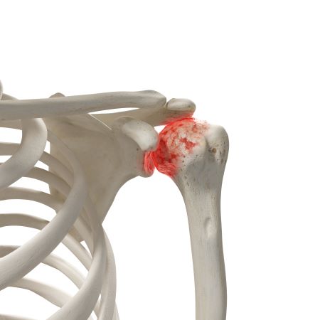 osteoartrita